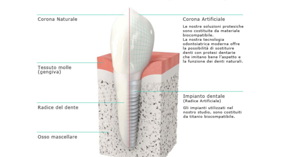 Implantologia Implantologia