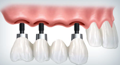 ponte su impianti dentali