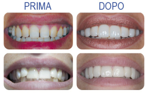 Faccette estetiche in ceramica per denti