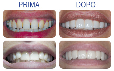 Faccette estetiche in ceramica per denti