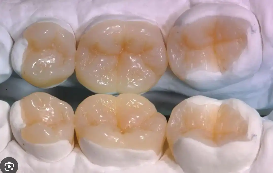 Protesi Fissa, Mobile e Scheletrata Studio Dentista Azzini Trento